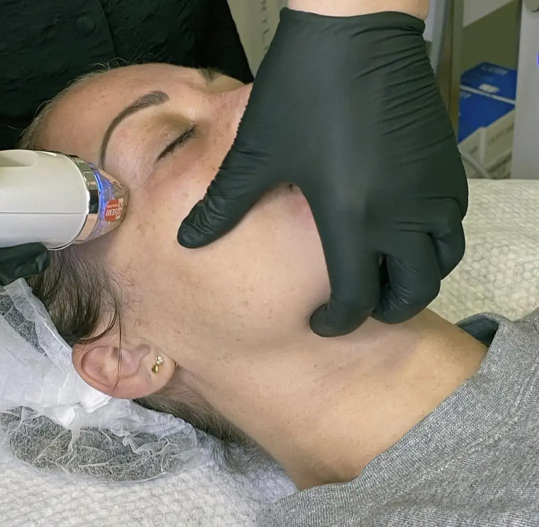Revitalizing Secret RF Micro Skin Needling session at Skinn. Witness a woman in relaxation as a skilled professional performs the procedure, enhancing skin renewal and well-being through our specialised skincare services.